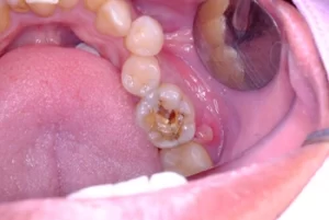 Can Tooth Decay Spread problem Can Tooth Decay Spread problem