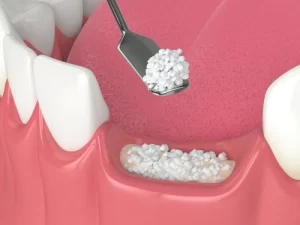 Diagram of socket preservation showing bone graft material placed into an empty tooth socket, topped with a collagen membrane Diagram of socket preservation showing bone graft material placed into an empty tooth socket, topped with a collagen membrane