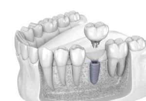how to relieve pain from dental implant application