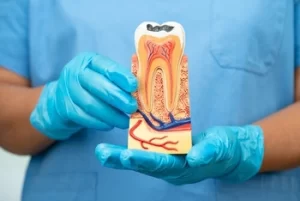 illustration of tooth with decay illustration of tooth with decay