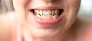 patient showing crooked bottom teeth patient showing crooked bottom teeth