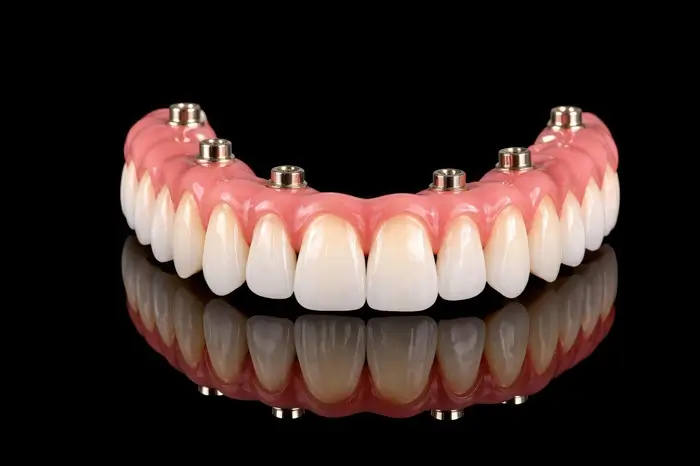 Who needs the Full Arch procedure