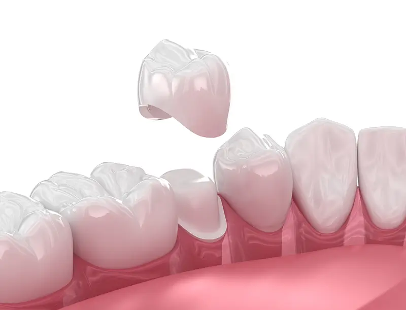Porcelain Crowns in Stanhope Gardens
