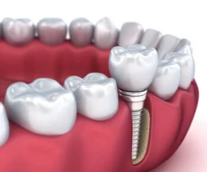 Truth About Dental Implants cost image Truth About Dental Implants cost image