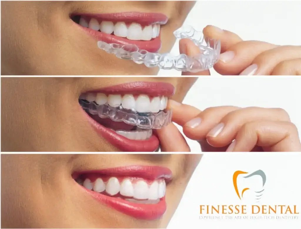 splint tooth grinding with finesse